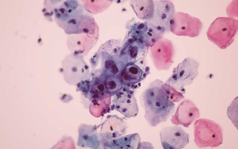 my ibms Microscopic of koilocyte cell criteria of hpv human papilloma virus infection pap smear shutterstock