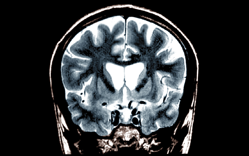 Huntingdon's disease brain scan