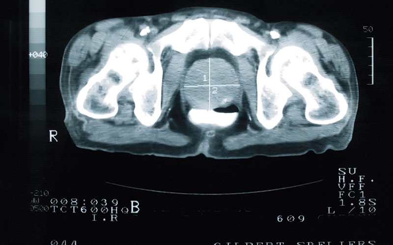 MRI for prostate cancer screening?