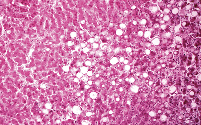 ≈-39-journal-synopsis-fatty-liver-light-micrograph-science-photo-library-c0359428.jpg