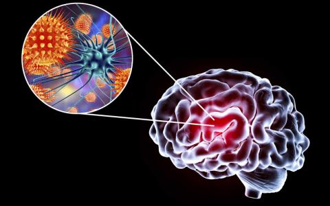 viral encephalitis 3d illustration showing brain CREDIT- Kateryna-Kon - shutterstock - 695144830