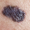 malignant-melanoma