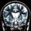Huntingdon's disease brain scan