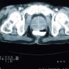 MRI for prostate cancer screening?