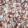 Ccear cell kidney cancer light micrograph -CREDIT - SPlibrary