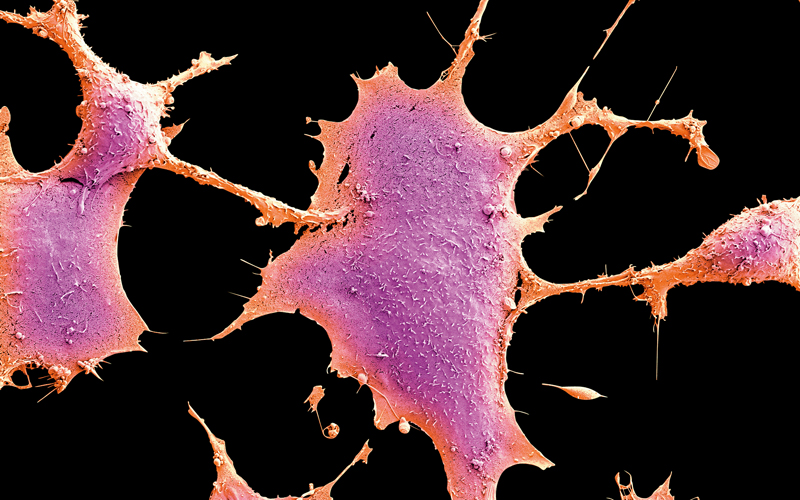 Breast cancer CREDIT - Science Photolibrary- C0584739