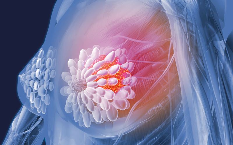 X-Ray illustration of Breast cancer - CREDIT - Science-Photolibrary