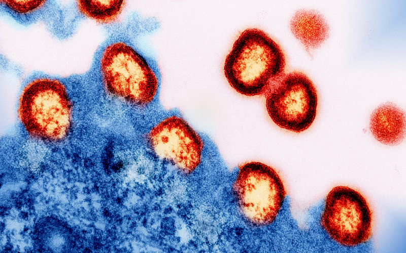 HIV-1-virus-particles - CREDIT-NATIONAL INSTITUTES OF HEALTH, NIAID SCIENCE PHOTO LIBRARY
