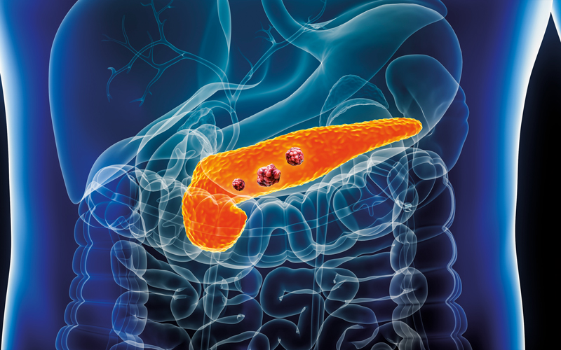 Pancreas or pancreatic cancer with organs and tumors or cancerous cells 3D rendering illustration with male bodyImage Credit | istock-1467893187